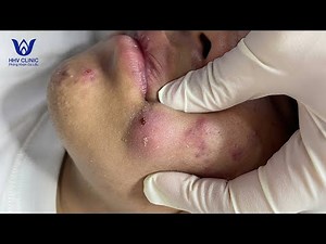Nặn mụn áp xe vùng miệng