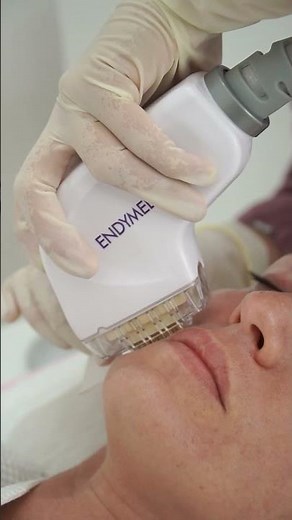 EndyMed FSR - 3DEEP RF Technology