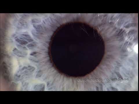 Close up of an Eye Reacting to Light, Larger Pupil After Dilation