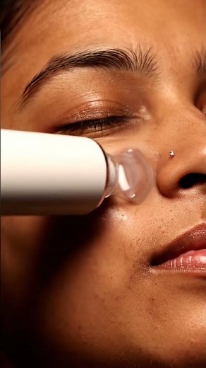 “Ultimate Blackhead Removal Vacuum — See the Pores Get Clean!”