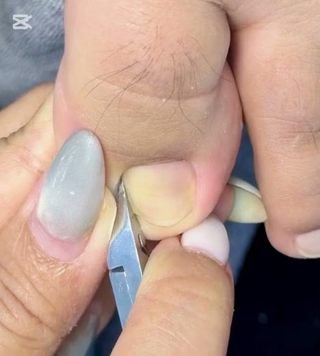 Thick toenail treatment How to treat toenail fungus fast