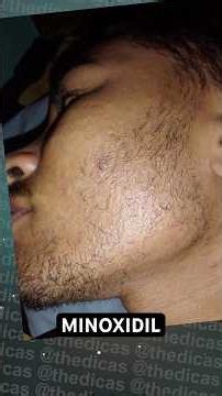 Minoxidil Evolução Barba / 1 ano kirkland #minoxidil #barba #thedicas