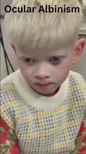 Ocular albinism| associated with Nystagmus| #Involuntaryeyemovement #albinism #nystagmus #ocular