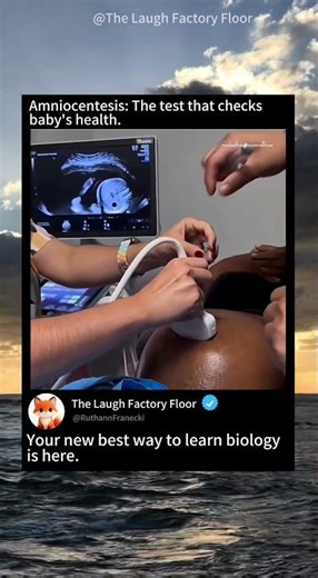 🤰🏻 Amniocentesis : test that checks 💉 the baby’s health 🧑‍⚕️ | MDCT