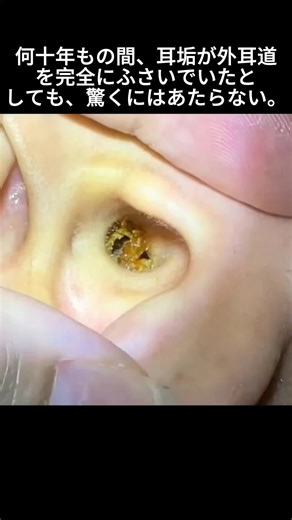 Satisfying Ear Wax Removal Video