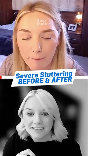 Life With Stuttering… Before and After Transformation 🤯
