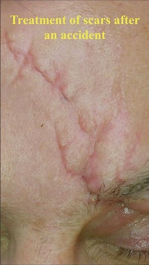 Treatment of forehead scars after an accident