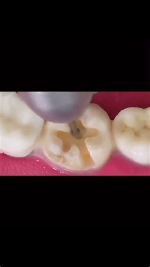 Root canal treatment procedure demonstrated on real teeth placed on a dental model 🦷 Взято у @whizdental #dentistry #dental #dentist #dentists #dentalstudent #dentalhygienist #dentalart #doctor #doctors #toothimplant #dentalrestorations #whizdental #dentalboards #dentalradiography #dentalveneers #dentalclinic #dentistrypalace #dentalclinicdesign #dentalimplants #teeth #tooth #dent #dentallogo #dentalassistant #dentalcare #dentalinstruments#стоматология#зубы | All Dental / Вся стоматология