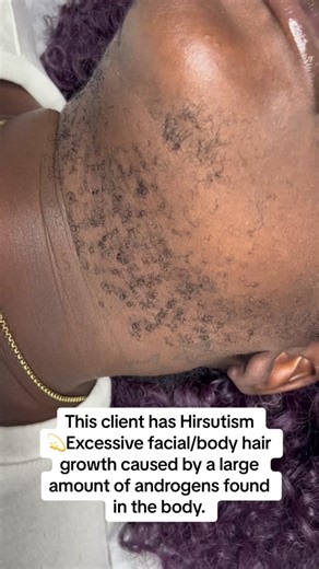 Hirsutism 101 ❤️🫶🏾💪🏾 #estheticianlife #foryou #fyp #waxerlife #waxingqueenadventures #foryoupage #educationalpurposes #educational #hirsutismwax #hirsutism #hirsutismawareness #pcos #pcosawareness #pcosproblems #pcosfighter #pcoslife