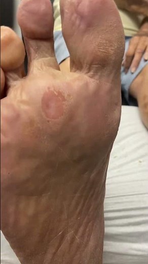 Watch a Podiatrist Remove Painful Foot Callus & Corn #FootCare #Podiatry