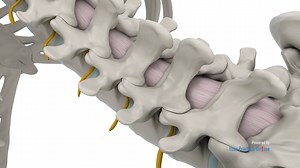 Minimally Invasive Lumbar Discectomy