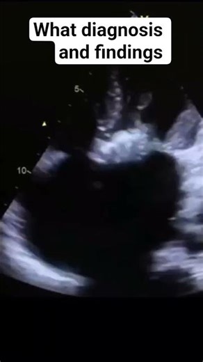 #hemodynamics #التغطيه #baby #echo
