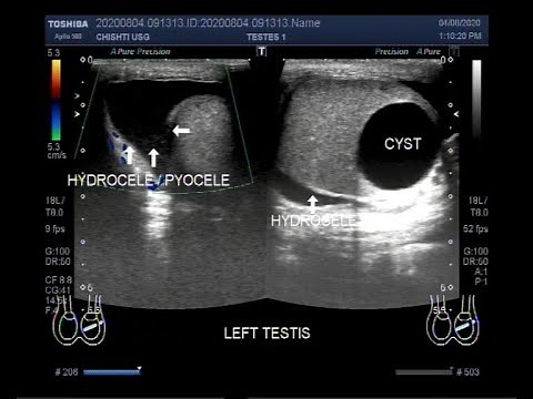 Ultrasound Video showing Hydrocele/Pyocele and an Intratesticular cyst.