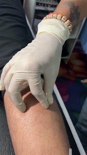 Dry Needling for Tight Calf Muscles | Trigger Point Therapy Explained