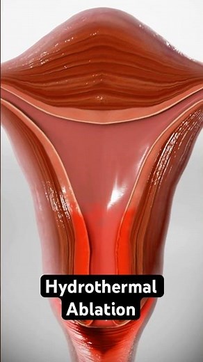 Using heated fluid to stop heavy periods (3D Animation)