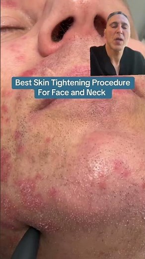 Best Skin Tightening Procedure For Face and Neck