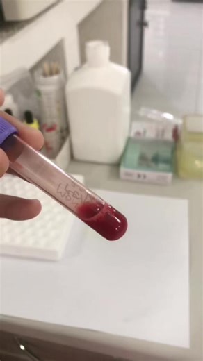 Understanding Severe Anemia: Blood Color Changes