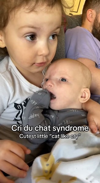 Understanding Cri du Chat Syndrome in Newborns