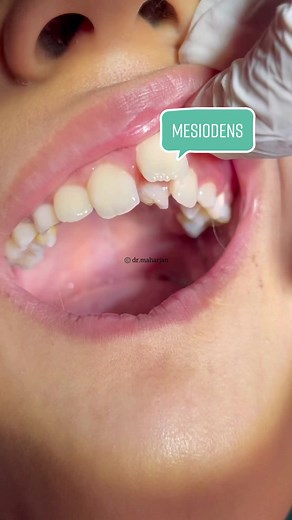 Understanding Mesiodens: A Detailed Insight