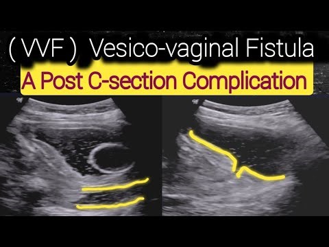 VVF ( Vesico vaginal Fistula ) Ultrasound - A Serious Complication of C section delivery