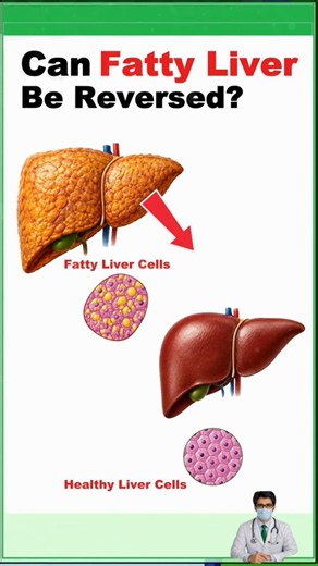 Can Fatty Liver Be Reversed?