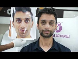 Post Operative Day 10 - Nasal Splints Removal After Nose Rhinoplasty