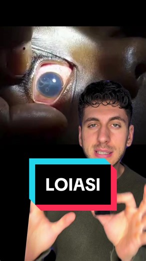 Cos’è la Loiasi? Infezione del nematode Loa Loa #occhio