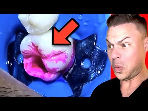 Orthodontist Reacts! INSANE Cavity Repair!
