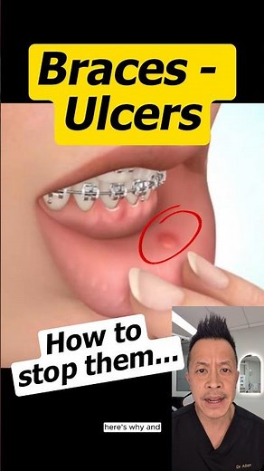 Why Do Braces Cause Ulcers? (And How to Fix It) #dentallan #dentist #shorts