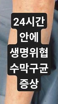 침습성 수막구균 감염증의 모든 것 하루 안에 생명을 위협할 수 있는 무서운 질병#shorts #건강정보