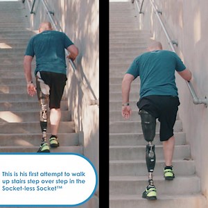Many amputees are limited in their activities due to discomfort and lack of stability and control. Socket-less Socket™ users have unequalled comfort and exceptional control of their prosthesis, and are often able to get back to activities they have not been able to do with conventional sockets. Talk to a Socket-less Socket™ expert here: https://bit.ly/3y6M4cJ | Martin Bionics