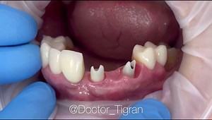 15K views · 244 reactions | Ovate pontic by Tigran Mnatsakanyan from our group #prosthodontics #dentalprosthesis | ZERODONTO | Facebook