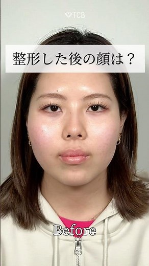 [Double Eyelid Surgery] Watch until the end!! #shorts