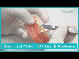 Forever Green | Bonding of Carriere® Motion 3D™ Class III Appliance
