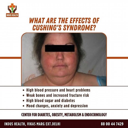 What Are the Effects of Cushing’s Syndrome?