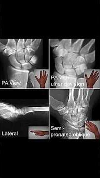 Master the Scaphoid PA Positioning in this detailed radiography tutorial! 📸#viral#shorts#aiimscre