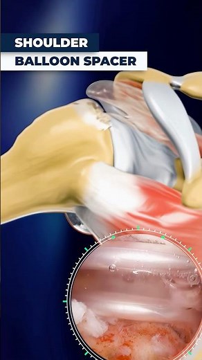 Surgeons Use Balloons to Fix Shoulder Pain Fast!
