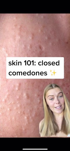 Skin 101: Understanding and Treating Closed Comedones
