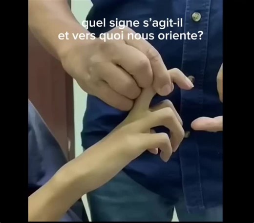 #neurology #medicalstudent #doctor #homme #diagnostic 👉🏻Le signe de Hoffmann est un réflexe pathologique utilisé en neurologie pour détecter une atteinte du motoneurone supérieur (voie pyramidale). Il montre une hyperexcitabilité des réflexes de la main.