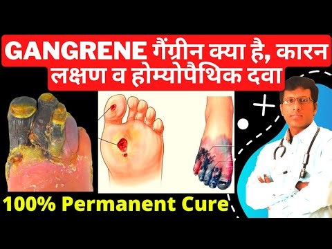 गैंग्रीन | Gangrene | Natural Homeopathy Medicine for Gangrene and Diabetic Foot Ulcer by dr mahesh