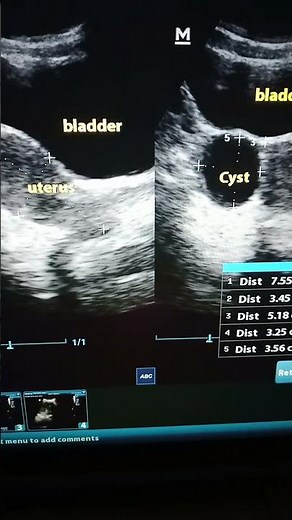 ✅Right simple ovarian Cyst #mom #ultrasound #love