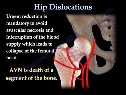 Hip Dislocations - Everything You Need To Know - Dr. Nabil Ebraheim
