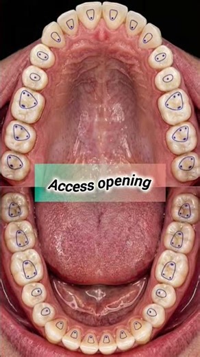 Access Opening in Endodontics Explained 🦷 | Tooth Anatomy Made Simple