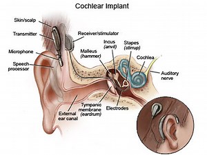 Cochlear Implants