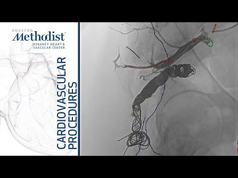 Embolization of Arteriovenous Malformation w/ Massive Buttock Hematoma–Part I (Lumsden MD, White MD)