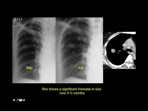 Solitary Pulmonary Nodule - Radiology Approach