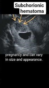 Subchorionic hematoma on ultrasound #radiology #pregnant #ultrasound #pregnancyscan