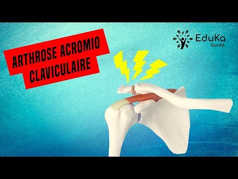 COMPRENDRE L'ARTHROSE ACROMIO CLAVICULAIRE