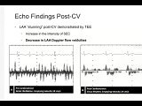 Use of Echo in the Evaluation of Cardiac Sources of Embolism • Video • MEDtube.net