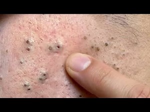 sac be spa blackheads elderly men face | sac be spa men face blackheads | sac be spa face massage 4k